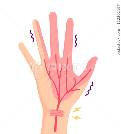 Causes of carpal tunnel syndrome and range of numbness Vector illustration (no text) Causes of carpal tunnel syndrome and range of numbness Vector illustration (no text) 112202197
