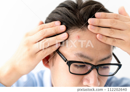 一個男人患有痤瘡 一個男人患有痤瘡 112202640