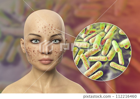 Acne vulgaris on skin and closeup view of bacteria Acne vulgaris on skin and closeup view of bacteria 112216460