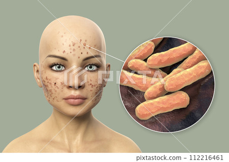 Acne vulgaris on skin and closeup view of bacteria Acne vulgaris on skin and closeup view of bacteria 112216461
