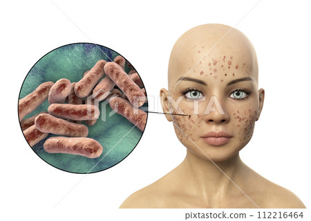 Acne vulgaris on skin and closeup view of bacteria Acne vulgaris on skin and closeup view of bacteria 112216464
