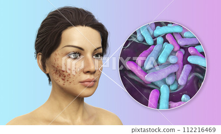 Acne vulgaris on skin and closeup view of bacteria Cutibacterium acnes Acne vulgaris on skin and closeup view of bacteria Cutibacterium acnes 112216469