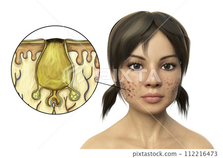 Acne vulgaris, black comedo Acne vulgaris, black comedo 112216473