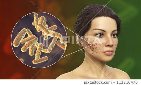 Acne vulgaris on skin Acne vulgaris on skin 112216476