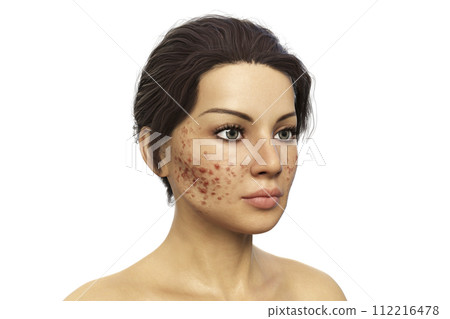 Acne vulgaris on skin 112216478