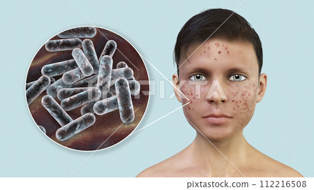 Acne vulgaris and bacteria Cutibacterium acnes Acne vulgaris and bacteria Cutibacterium acnes 112216508