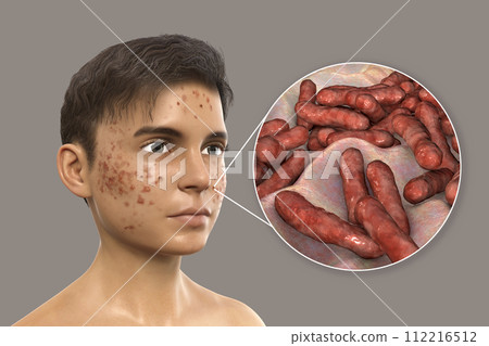 Acne vulgaris and bacteria Cutibacterium acnes 112216512