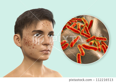 Acne vulgaris and bacteria Cutibacterium acnes 112216513