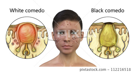 Acne vulgaris in a teenager boy, white and black comedo Acne vulgaris in a teenager boy, white and black comedo 112216518