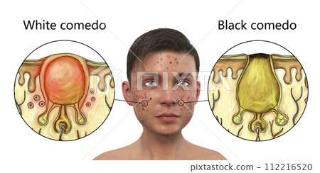 Acne vulgaris in a teenager boy, white and black comedo 112216520