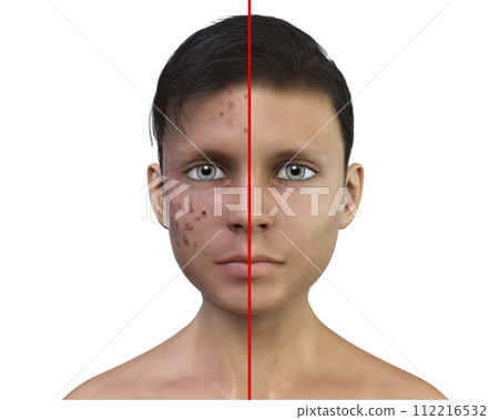 Acne vulgaris in a teenager boy Acne vulgaris in a teenager boy 112216532