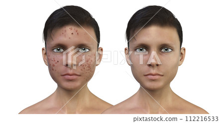 Acne vulgaris in a teenager boy 112216533