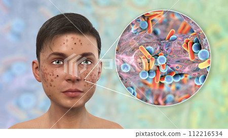 Acne, pimples, and closeup view of bacteria, the causative agents of skin lesions Acne, pimples, and closeup view of bacteria, the causative agents of skin lesions 112216534