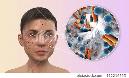 Acne, pimples, and closeup view of bacteria, the causative agents of skin lesions 112216535