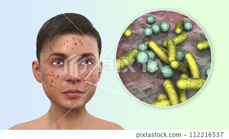 Acne, pimples, and closeup view of bacteria, the causative agents of skin lesions 112216537