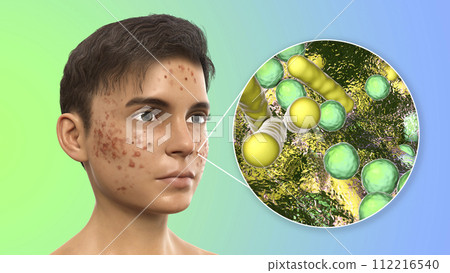 Acne, pimples, and closeup view of bacteria, the causative agents of skin lesions Acne, pimples, and closeup view of bacteria, the causative agents of skin lesions 112216540