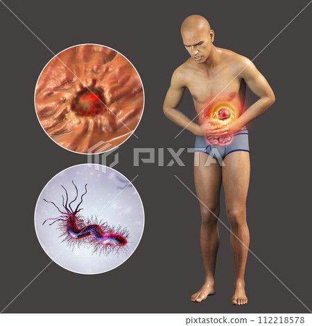 Pain in stomach, gastric ulcer, conceptual 3D illustration Pain in stomach, gastric ulcer, conceptual 3D illustration 112218578