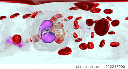 360-degree spherical panorama of blood with eosinophilia 112218900