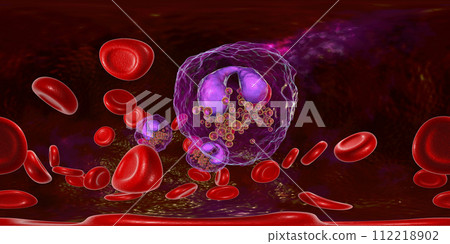 360-degree spherical panorama of blood with eosinophilia 112218902