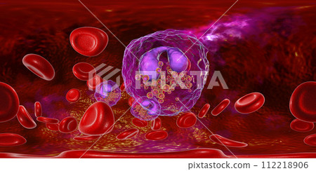 360-degree spherical panorama of blood with eosinophilia 112218906