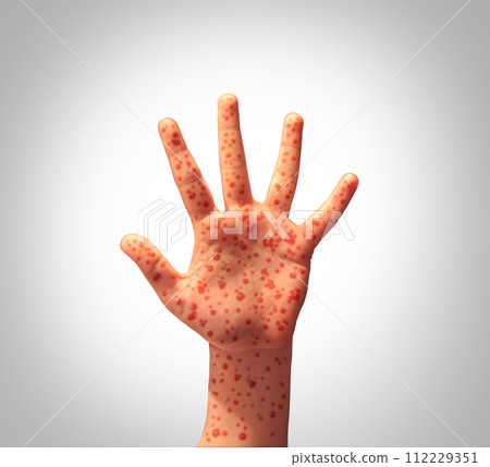 Measles Disease Outbreak 112229351