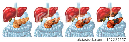 Pancreatic Cancer Stages 112229357