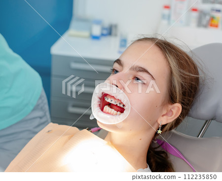 Concept of dental care. Enlarged image of ceramic and metal braces on teeth 112235850
