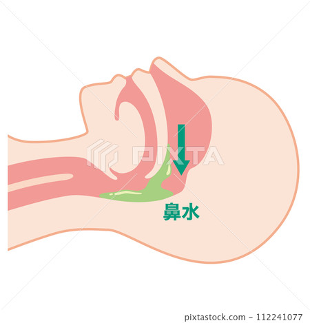 Postnasal drip, supine Postnasal drip, supine 112241077