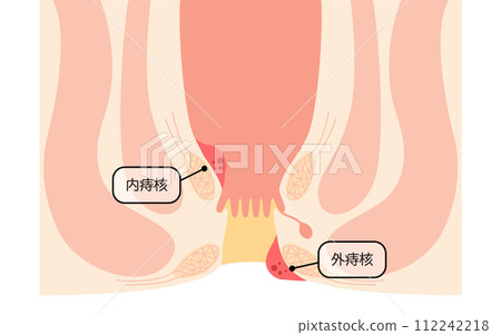 Anal disease, hemorrhoids/wart hemorrhoids illustrated illustrations, cross-sectional view Anal disease, hemorrhoids/wart hemorrhoids illustrated illustrations, cross-sectional view 112242218