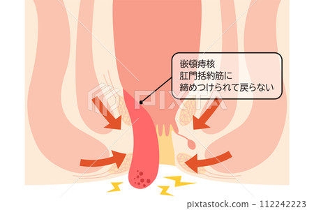 Anal disease, hemorrhoids/wart hemorrhoids "incarcerated hemorrhoids" Illustrated illustrations, cross-sectional views 112242223