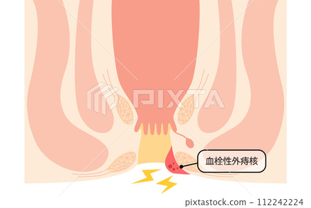 Anal disease, hemorrhoids/wart hemorrhoids "thrombotic external hemorrhoids" Illustrated illustration, cross-sectional view Anal disease, hemorrhoids/wart hemorrhoids "thrombotic external hemorrhoids" Illustrated illustration, cross-sectional view 112242224