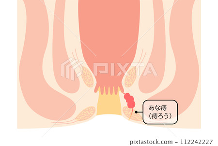 Anal disease, hemorrhoids "Anal hemorrhoids" Illustrated illustration, cross-sectional view Anal disease, hemorrhoids "Anal hemorrhoids" Illustrated illustration, cross-sectional view 112242227
