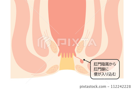 肛門疾病，痔瘡「肛門痔瘡」插圖，橫斷面圖 112242228