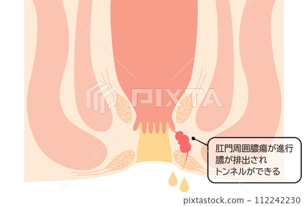 肛門疾病，痔瘡「肛門痔瘡」插圖，橫斷面圖 112242230