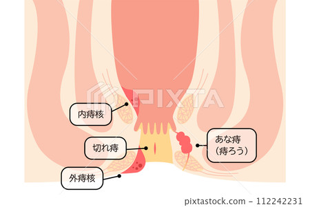 肛門疾病、痔瘡、痔瘡、痔瘡、痔瘡、說明圖、剖面圖 肛門疾病、痔瘡、痔瘡、痔瘡、痔瘡、說明圖、剖面圖 112242231
