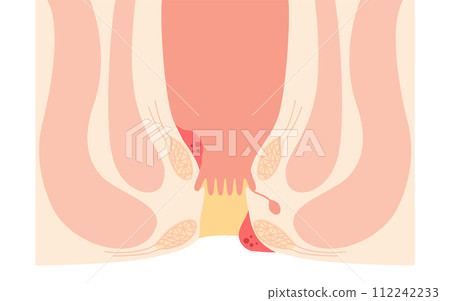 肛門疾病、痔瘡/疣痔插圖、橫切面圖 112242233