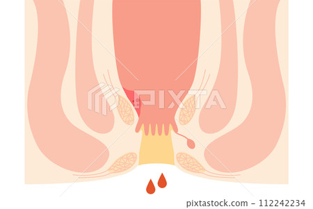 肛門疾病、痔瘡/疣痔「I 級內痔」插圖，橫斷面圖 112242234