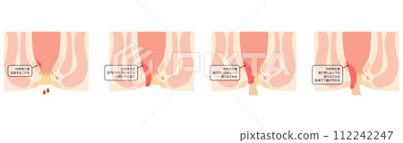 Anal disease, hemorrhoids/wart hemorrhoids "internal hemorrhoids grade I to IV" Illustrated illustration, cross-sectional view Anal disease, hemorrhoids/wart hemorrhoids "internal hemorrhoids grade I to IV" Illustrated illustration, cross-sectional view 112242247