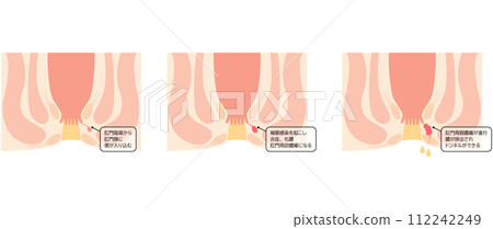 肛門疾病，痔瘡「肛門痔瘡」插圖，橫斷面圖 112242249