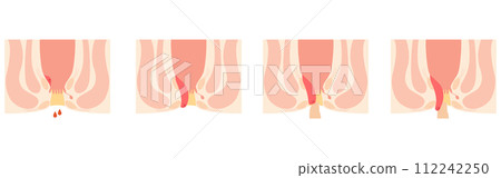 Anal disease, hemorrhoids/wart hemorrhoids "internal hemorrhoids grade I to IV" Illustrated illustration, cross-sectional view 112242250