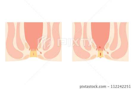 Anal diseases, hemorrhoids "hemorrhoids, anal ulcers, anal stenosis, anal polyps" Illustrated illustrations, cross-sectional views 112242251