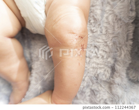 寶寶左腳有刮痕 寶寶左腳有刮痕 112244367