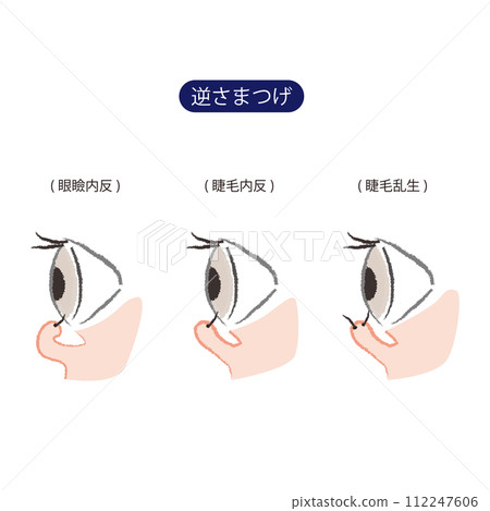 倒睫毛的3種類型(眼瞼內翻、睫毛內翻、睫毛內翻) 倒睫毛的3種類型(眼瞼內翻、睫毛內翻、睫毛內翻) 112247606