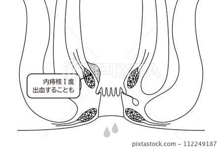 Anal disease, hemorrhoids/wart hemorrhoids "internal hemorrhoids grade I" Illustrated illustration, cross-sectional view 112249187
