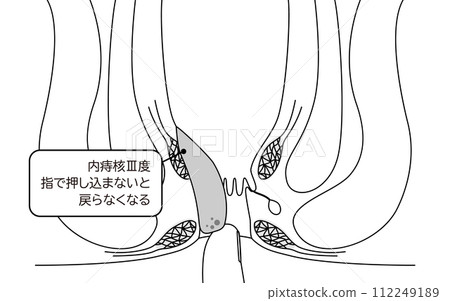Anal disease, hemorrhoids/wart hemorrhoids "internal hemorrhoids grade III" Illustrated illustration, cross-sectional view Anal disease, hemorrhoids/wart hemorrhoids "internal hemorrhoids grade III" Illustrated illustration, cross-sectional view 112249189