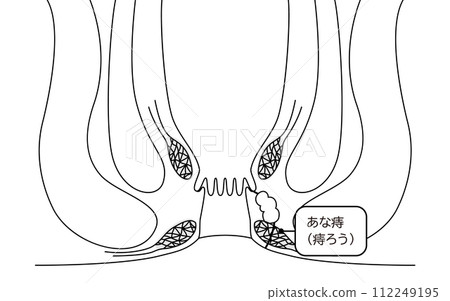 肛門疾病，痔瘡「肛門痔瘡」插圖，橫斷面圖 112249195