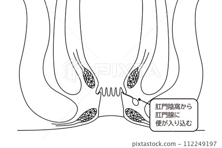 Anal disease, hemorrhoids "Anal hemorrhoids" Illustrated illustration, cross-sectional view 112249197