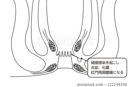 Anal disease, hemorrhoids "Anal hemorrhoids" Illustrated illustration, cross-sectional view 112249198