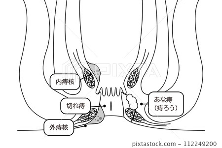 肛門疾病、痔瘡、痔瘡、痔瘡、痔瘡、說明圖、剖面圖 肛門疾病、痔瘡、痔瘡、痔瘡、痔瘡、說明圖、剖面圖 112249200