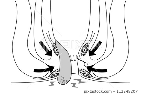 Anal disease, hemorrhoids/wart hemorrhoids "incarcerated hemorrhoids" Illustrated illustrations, cross-sectional views 112249207
